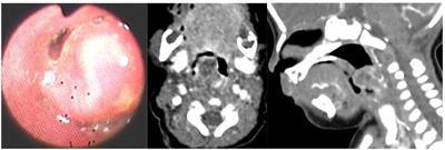 Pediatric bronchogenic cysts in the head and neck region: A study of 10 surgical cases and a review of the literature